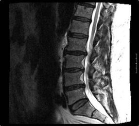 x-ray e shtyllës së qafës së mitrës me osteokondrozë