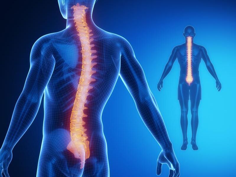 Osteokondroza e shtyllës kurrizore, që kërkon trajtim kompleks