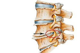 disk i mbërthyer i shtyllës kurrizore si shkak i osteokondrozës së qafës së mitrës